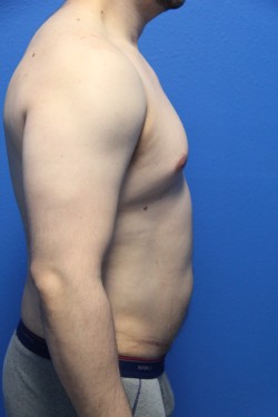 Case--5924 | Before Liposuction 3