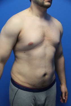 Case--5924 | Before Liposuction 2