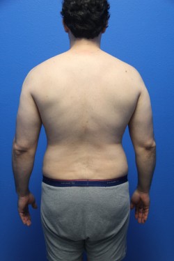 Case--5924 | Before Liposuction 4