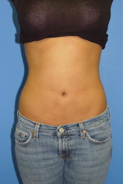 Case--2213 | After Liposuction 1