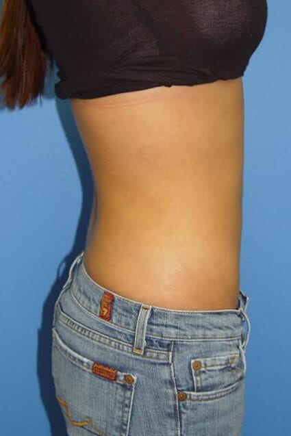 Case--2213 | After Liposuction 2