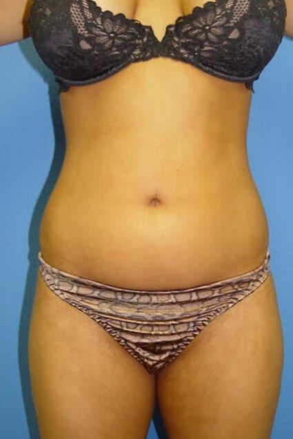 Case--2213 | Before Liposuction 1
