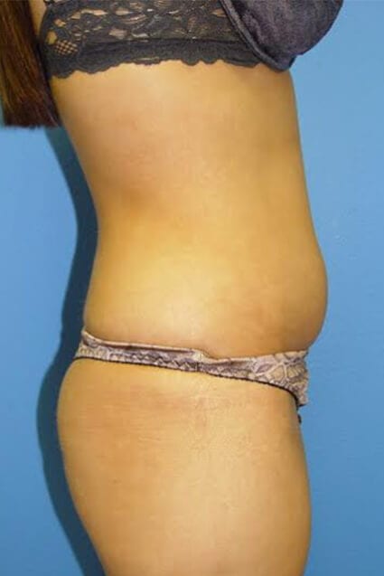 Case--2213 | Before Liposuction 2