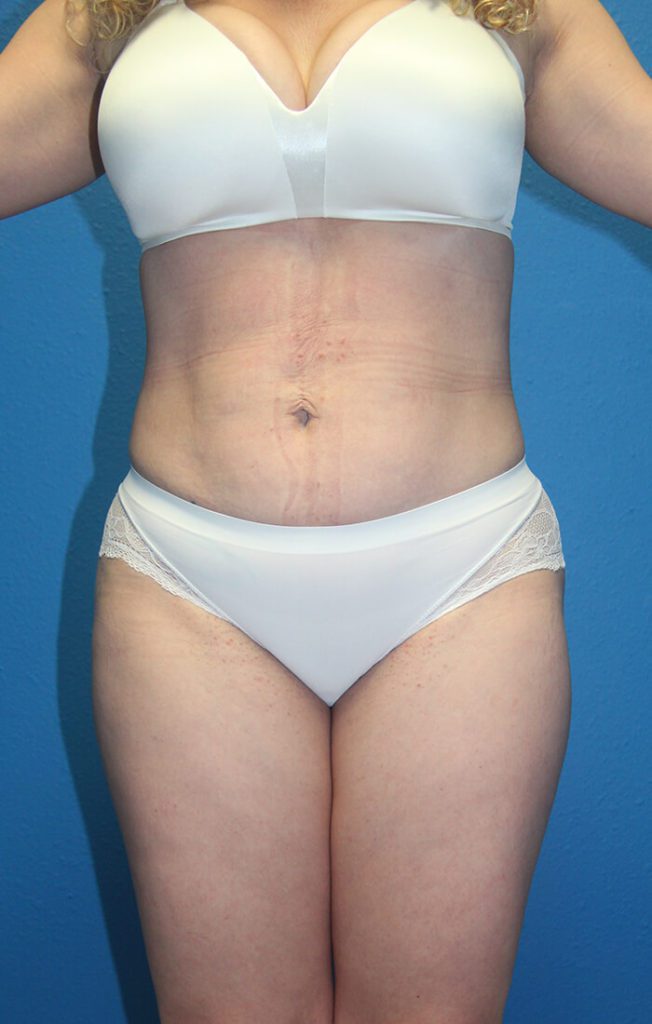 Case--1760 | After Liposuction 1