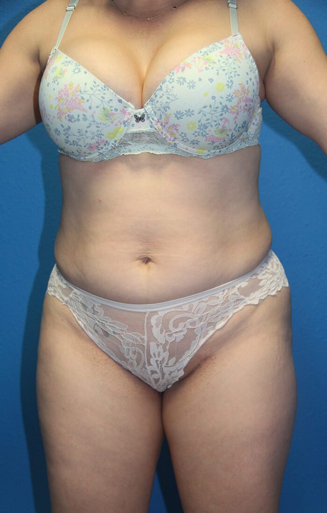 Case--1760 | Before Liposuction 1