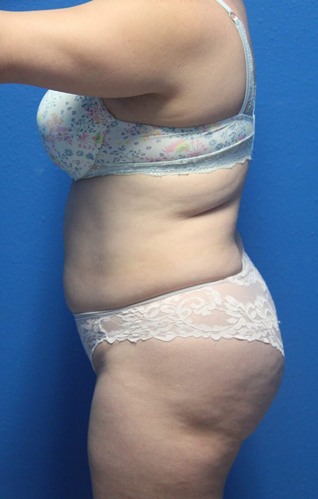 Case--1760 | Before Liposuction 2