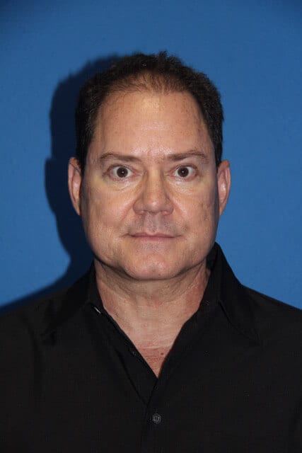 Case--7376 | After Male Facelift 1