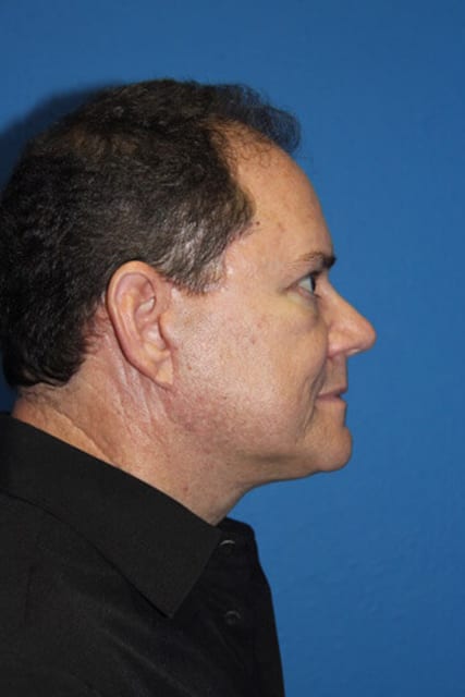 Case--7376 | After Male Facelift 3