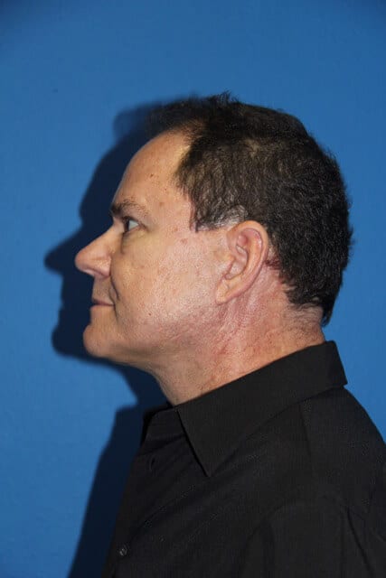 Case--7376 | After Male Facelift 5