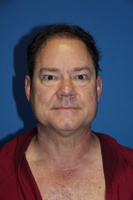 Case--7376 | Before Male Facelift 1