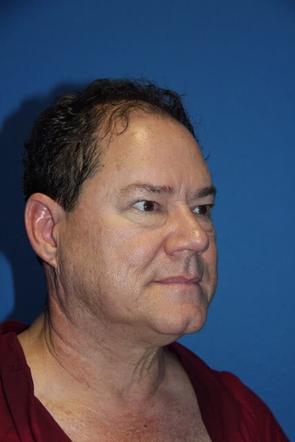 Case--7376 | Before Male Facelift 2