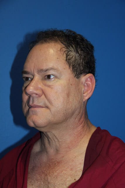 Case--7376 | Before Male Facelift 4