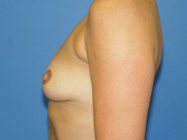 Case--1357 | Before Breast Augmentation 5