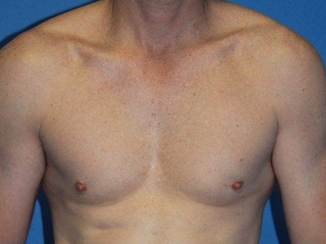 Case--8792 | After Male Pectoral Enlargement / Pec Implants 1