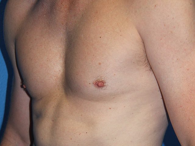 Case--8792 | After Male Pectoral Enlargement / Pec Implants 2