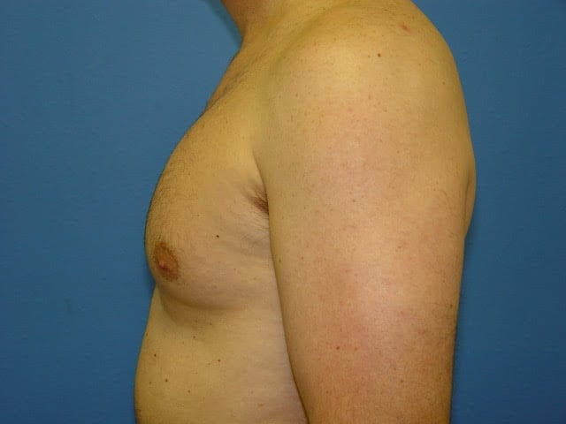 Case--2676 | After Male Pectoral Enlargement / Pec Implants 1