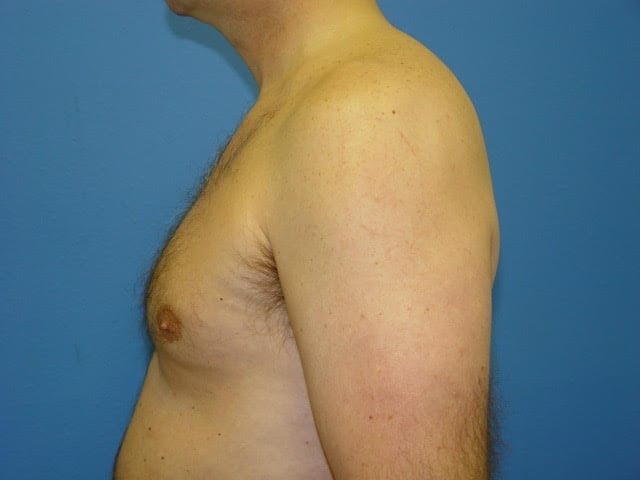 Case--2676 | Before Male Pectoral Enlargement / Pec Implants 1