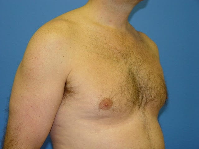 Case--2676 | Before Male Pectoral Enlargement / Pec Implants 2