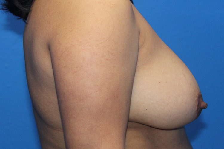 Case--4904 | Before Breast Implant Removal and Breast Lift 2