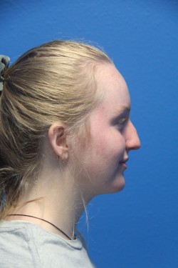 Case--1587 | Before Face 3