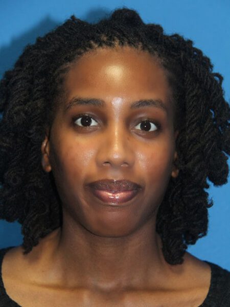 Case--9081 | After Nose Surgery / Rhinoplasty 1