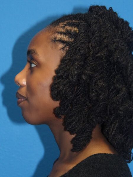 Case--9081 | After Nose Surgery / Rhinoplasty 2