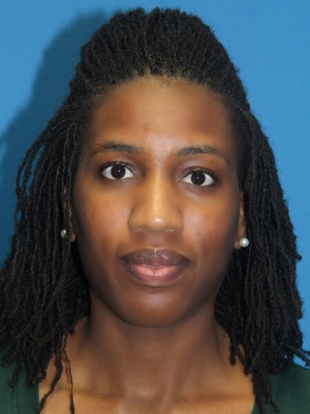 Case--9081 | Before Nose Surgery / Rhinoplasty 1