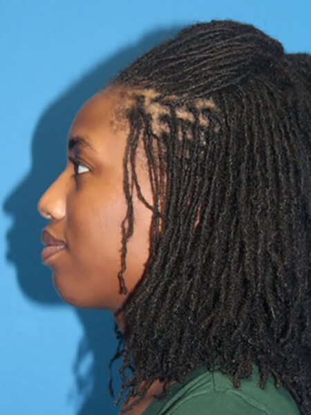 Case--9081 | Before Nose Surgery / Rhinoplasty 2