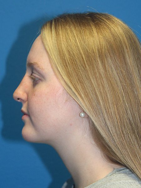 Case--5986 | After Nose Surgery / Rhinoplasty 1