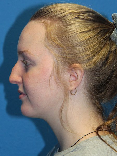 Case--5986 | Before Nose Surgery / Rhinoplasty 1