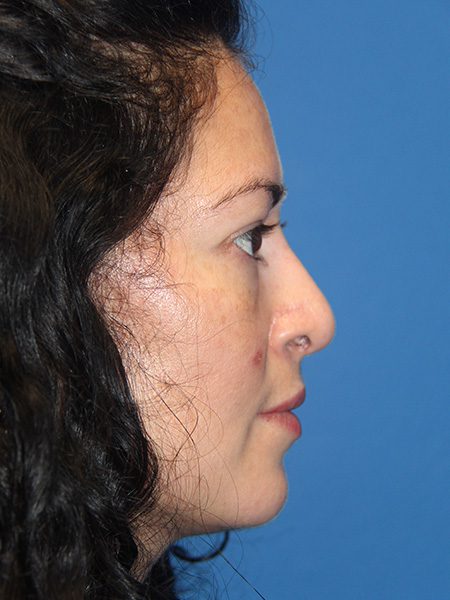 Case--4221 | After Nose Surgery / Rhinoplasty 1