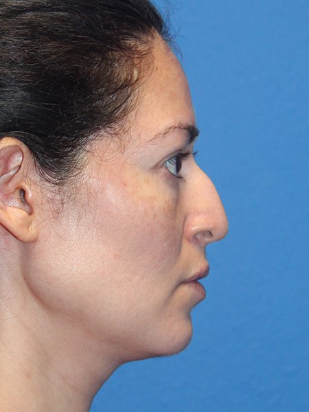 Case--4221 | Before Nose Surgery / Rhinoplasty 1