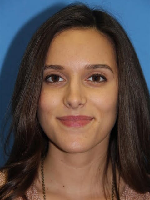 Case--8160 | After Nose Surgery / Rhinoplasty 1