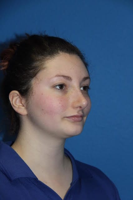 Case--8227 | After Nose Surgery / Rhinoplasty 1