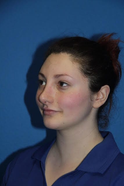 Case--8227 | After Nose Surgery / Rhinoplasty 2