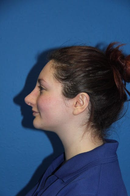 Case--8227 | After Nose Surgery / Rhinoplasty 3