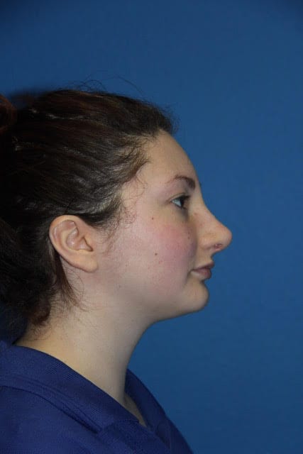 Case--8227 | After Nose Surgery / Rhinoplasty 4