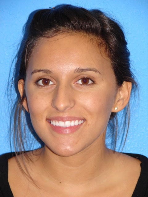 Case--8160 | Before Nose Surgery / Rhinoplasty 1