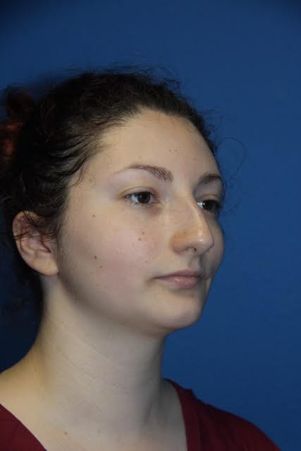 Case--8227 | Before Nose Surgery / Rhinoplasty 1
