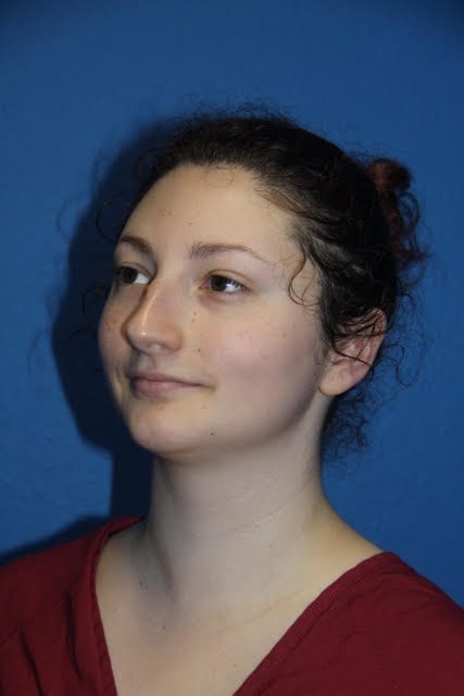 Case--8227 | Before Nose Surgery / Rhinoplasty 2