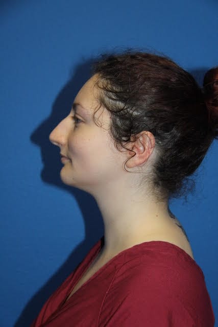 Case--8227 | Before Nose Surgery / Rhinoplasty 3