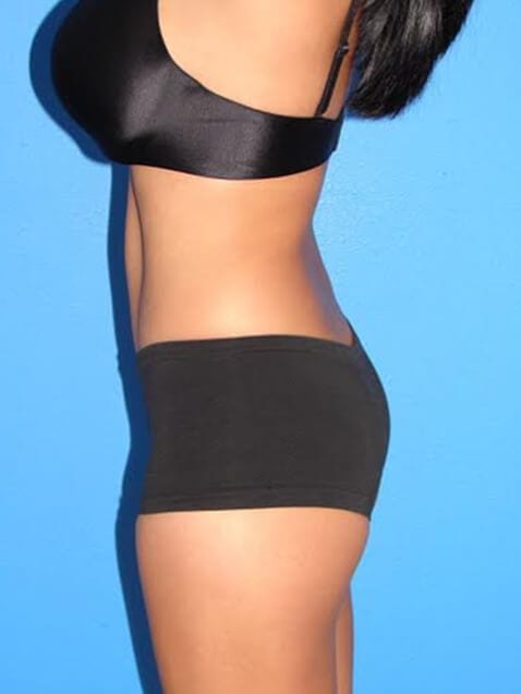 Case--5671 | After Tummy Tuck 3