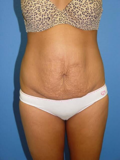 Case--5671 | Before Tummy Tuck 1