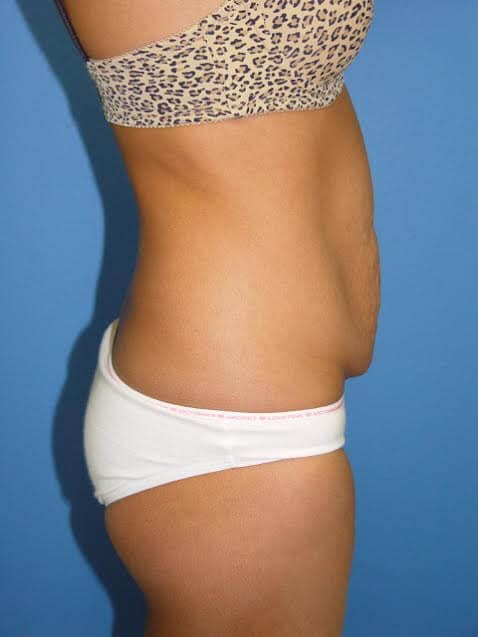 Case--5671 | Before Tummy Tuck 5