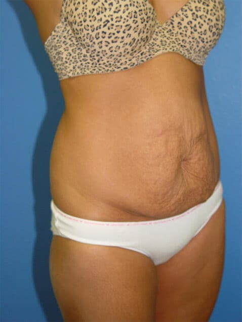 Case--5671 | Before Tummy Tuck 4