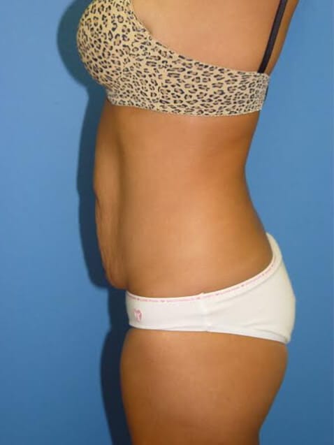 Case--5671 | Before Tummy Tuck 3