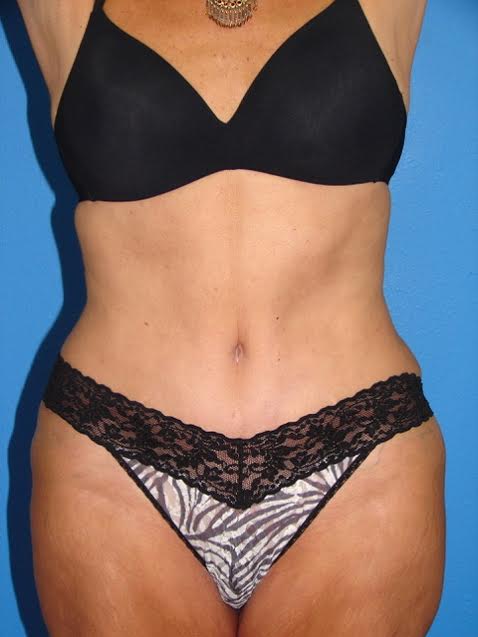 Case--1166 | After Tummy Tuck 1