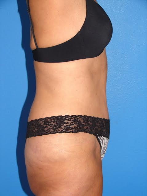 Case--1166 | After Tummy Tuck 3