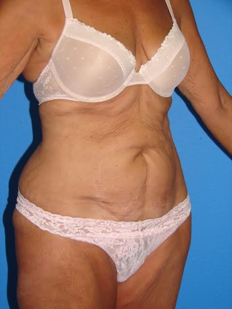 Case--1166 | Before Tummy Tuck 2