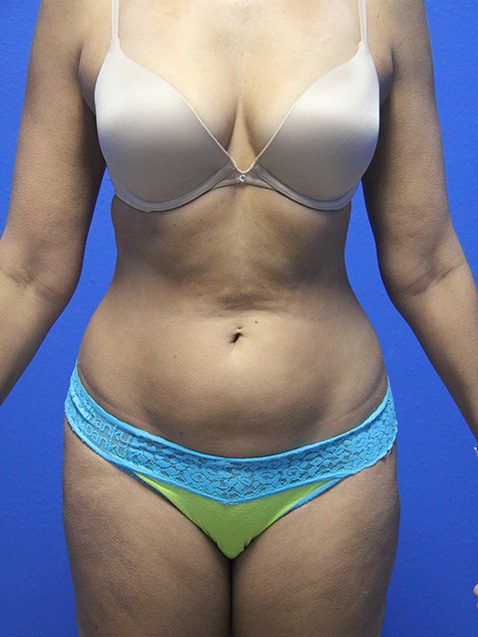 Case--8274 | Before Tummy Tuck 1